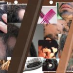 Alopecia – Hair Loss Problem