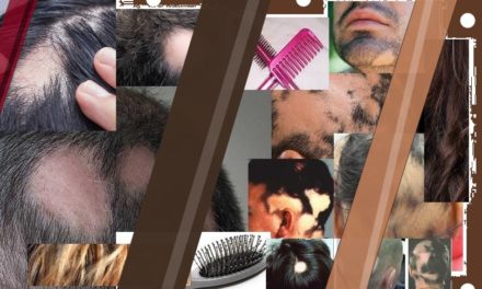 Alopecia – Hair Loss Problem